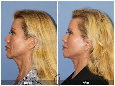Facelift 50s Before & After Gallery - Patient 171081 - Image 1