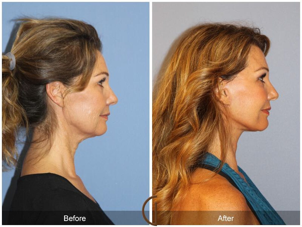 Facelift 50s Before & After Gallery - Patient 152958 - Image 3