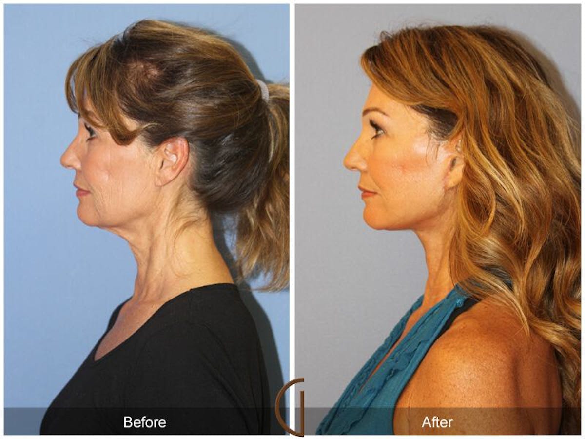 Facelift 50s Before & After Gallery - Patient 152958 - Image 1