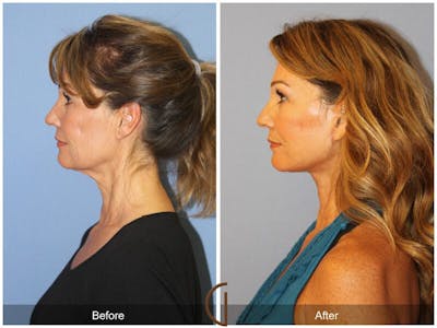 Facelift 50s Before & After Gallery - Patient 152958 - Image 1