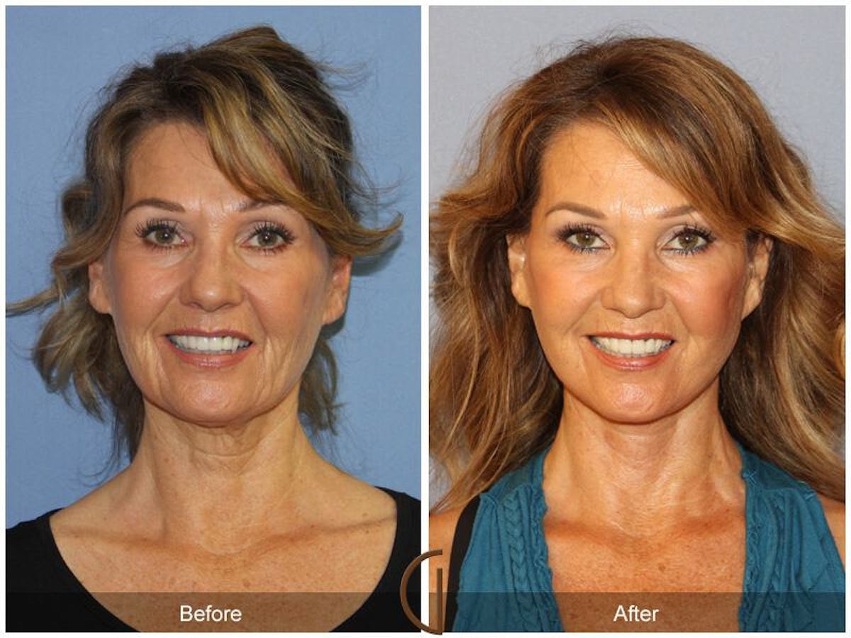 Facelift 50s Before & After Gallery - Patient 152958 - Image 2