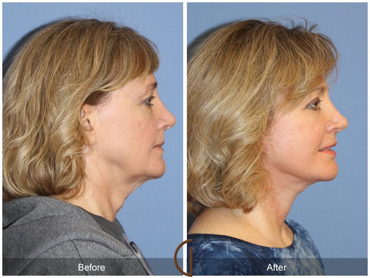 Facelift 50s Before & After Gallery - Patient 293903 - Image 3