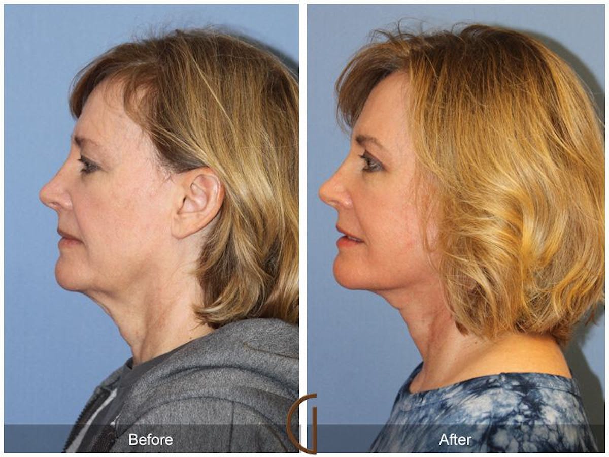 Facelift 50s Before & After Gallery - Patient 293903 - Image 1