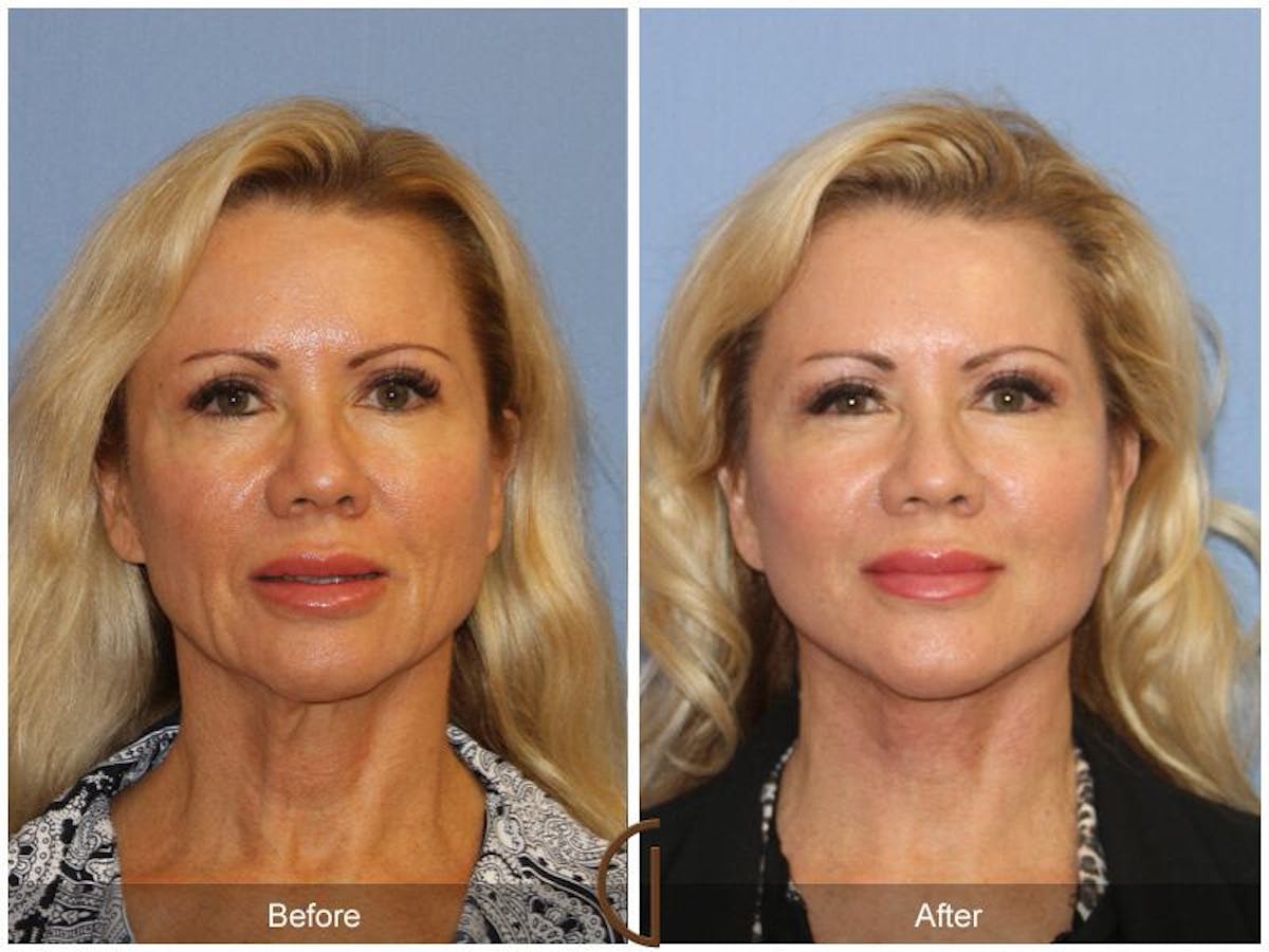 Facelift 50s Before & After Gallery - Patient 171081 - Image 2