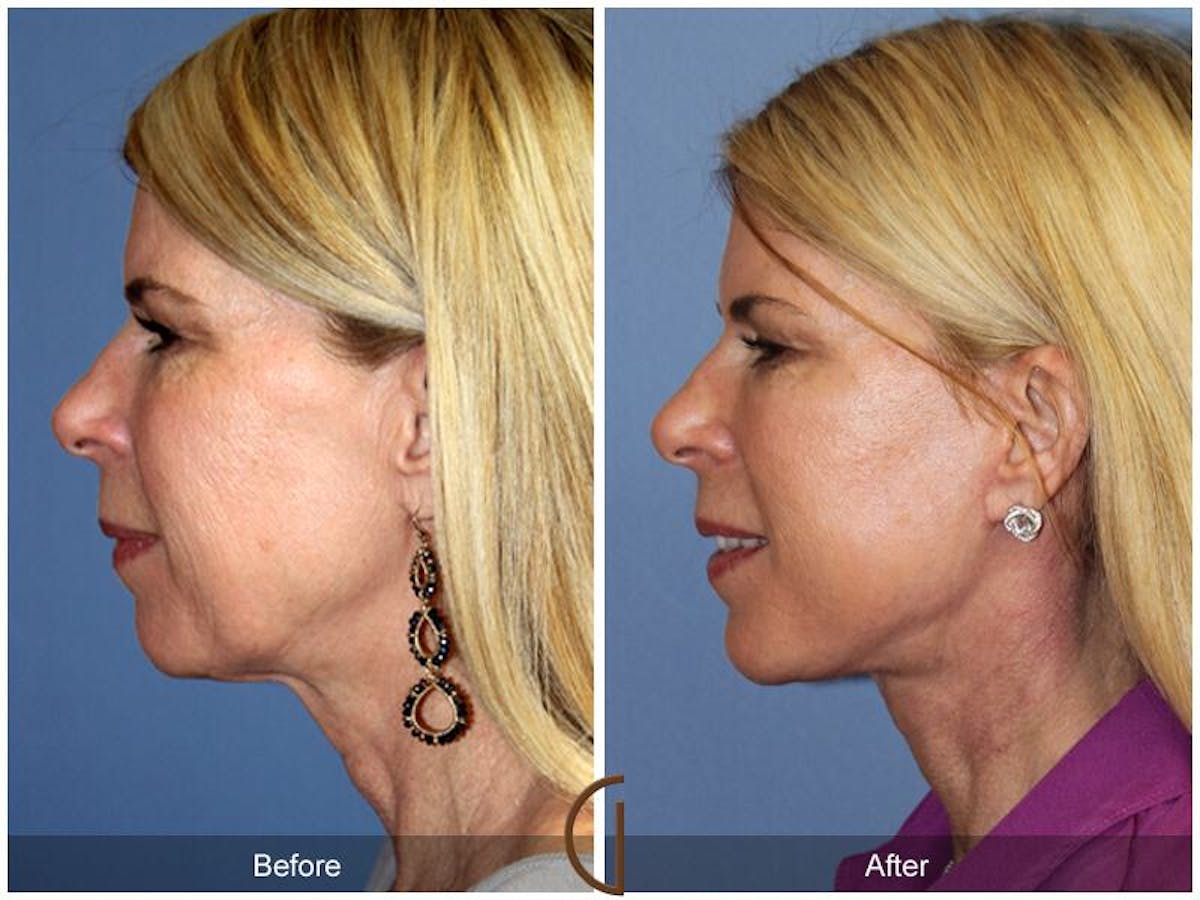 Facelift 50s Before & After Gallery - Patient 713894 - Image 1