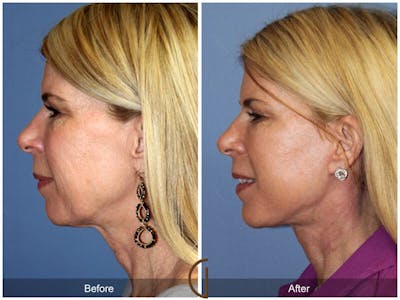 Facelift 50s Before & After Gallery - Patient 713894 - Image 1