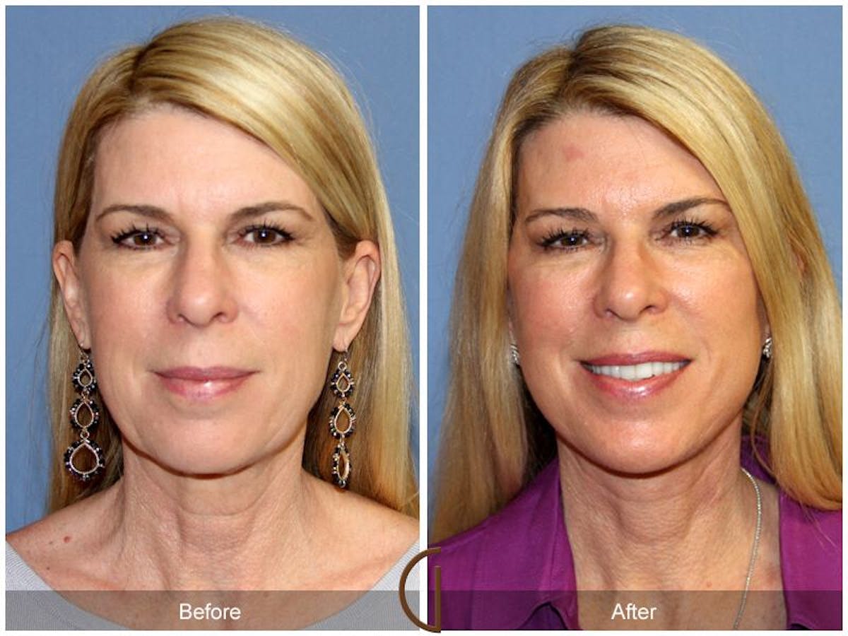 Facelift 50s Before & After Gallery - Patient 713894 - Image 2