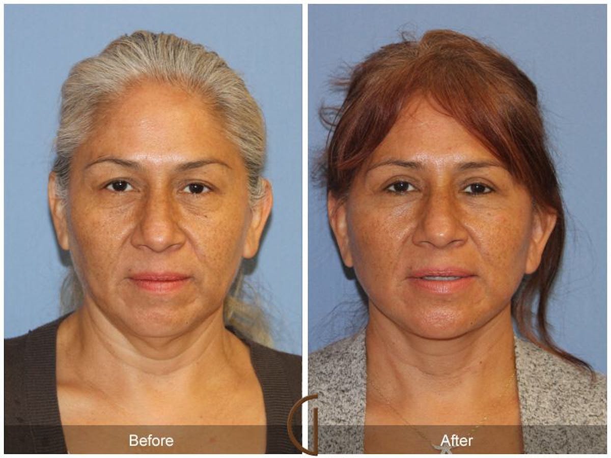 Facelift 50s Before & After Gallery - Patient 883773 - Image 2