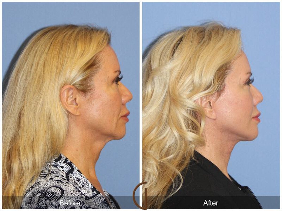 Facelift 50s Before & After Gallery - Patient 171081 - Image 3
