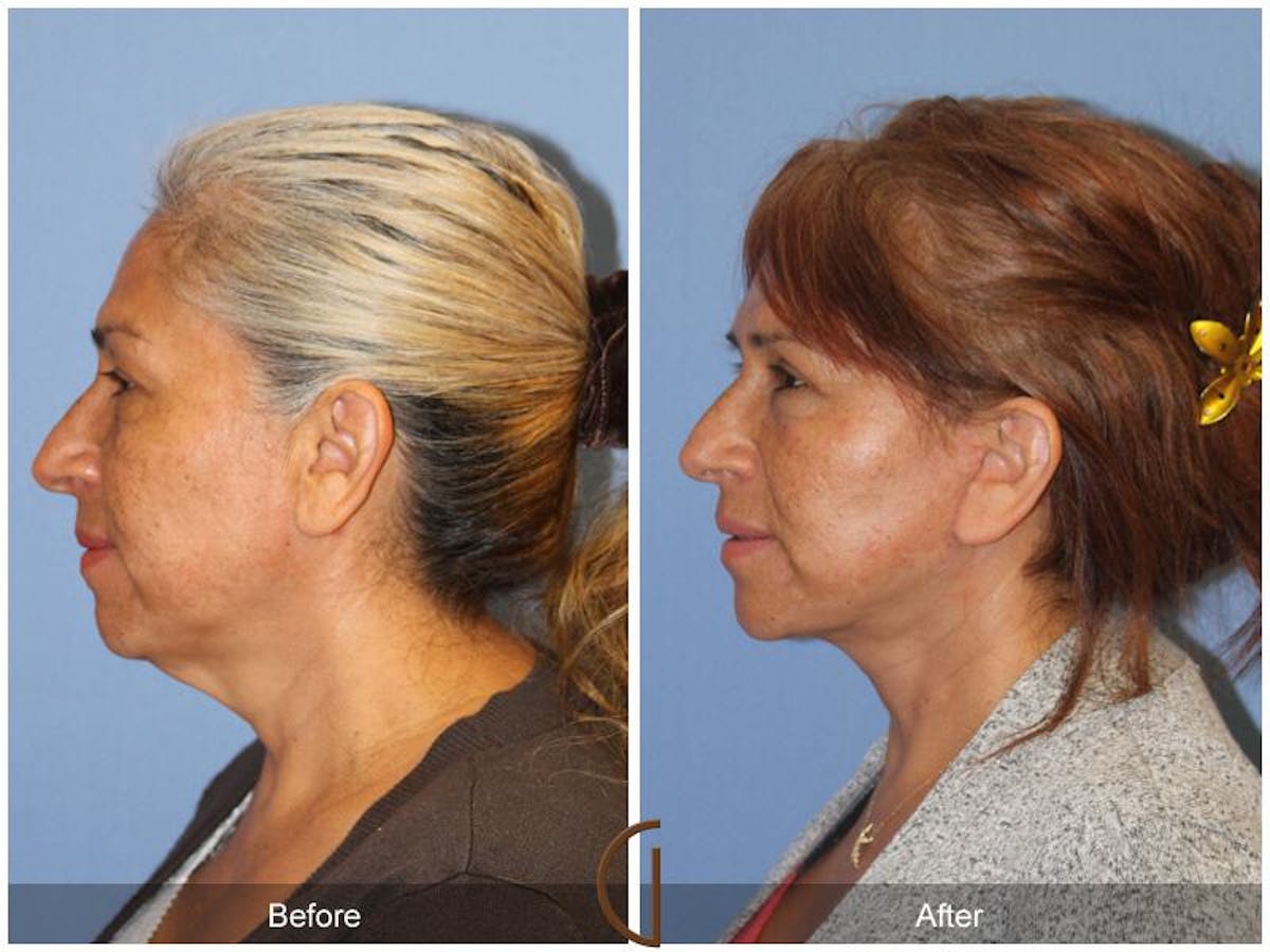 Facelift 50s Before & After Gallery - Patient 883773 - Image 1