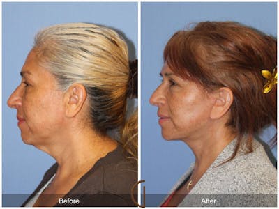 Facelift 50s Before & After Gallery - Patient 883773 - Image 1