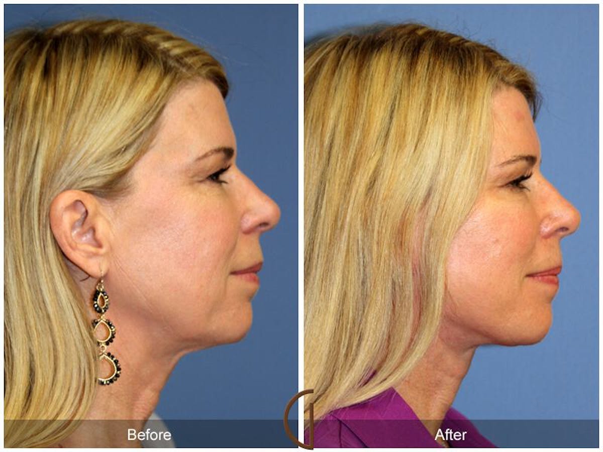 Facelift 50s Before & After Gallery - Patient 713894 - Image 3
