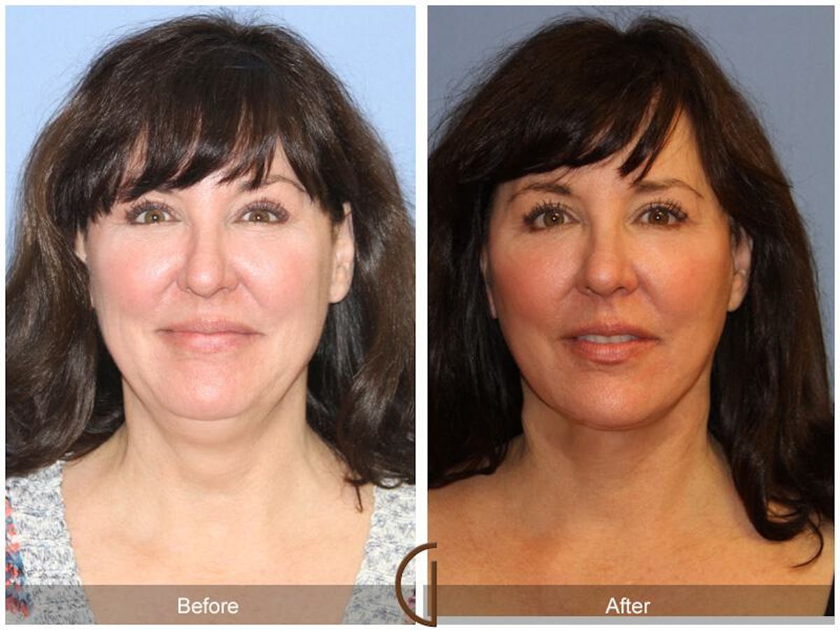 Facelift 40s Before & After Gallery - Patient 139282 - Image 2