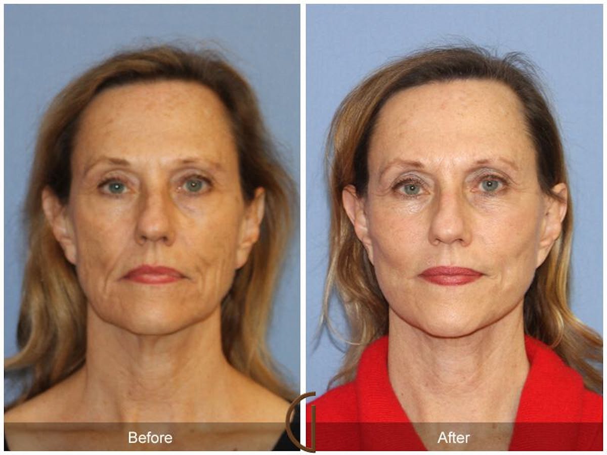 Facelift 50s Before & After Gallery - Patient 263333 - Image 2