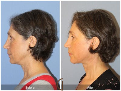 Facelift 50s Before & After Gallery - Patient 238316 - Image 1