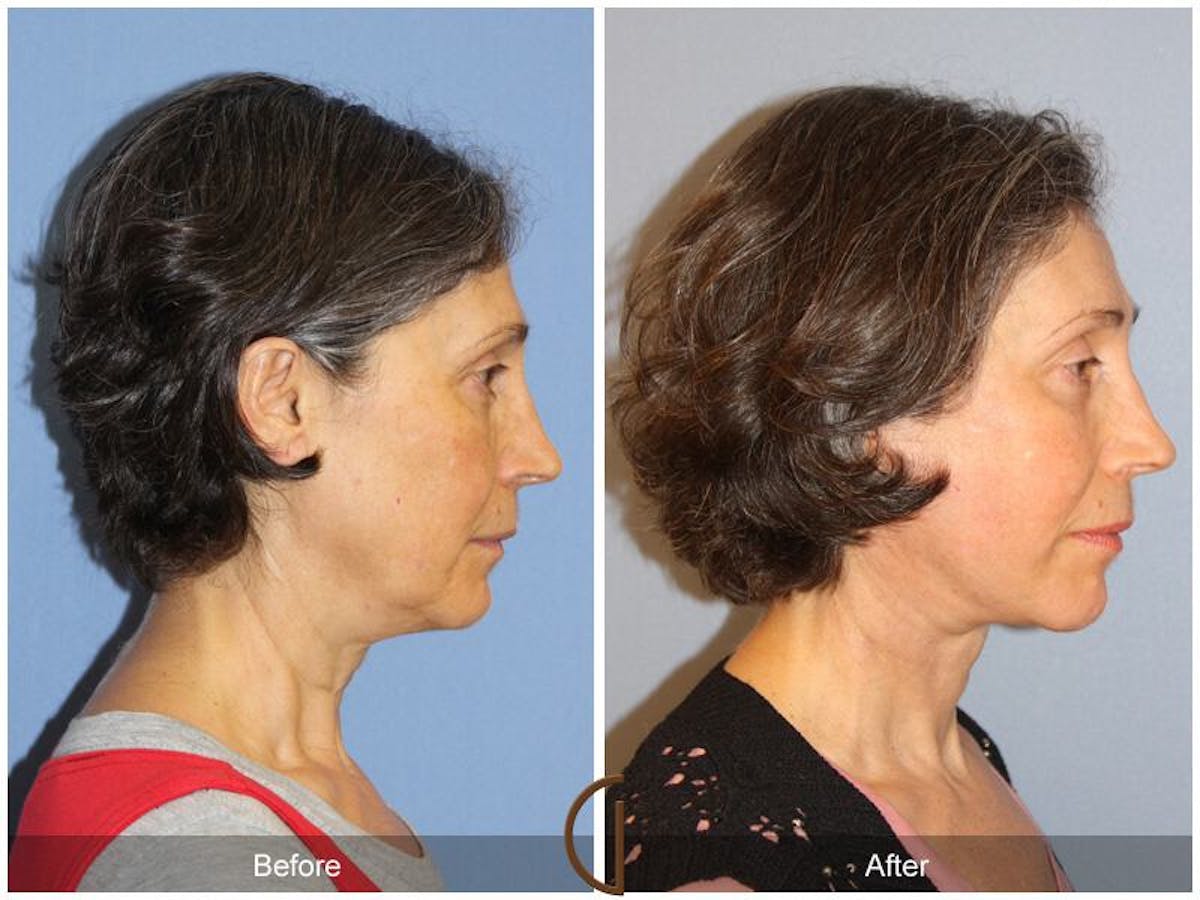 Facelift 50s Before & After Gallery - Patient 238316 - Image 3