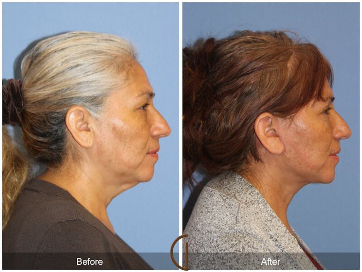 Facelift 50s Before & After Gallery - Patient 883773 - Image 3