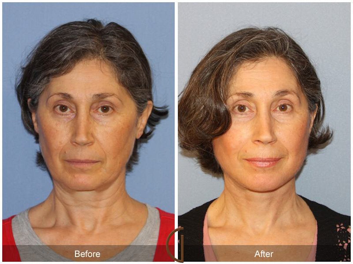 Facelift 50s Before & After Gallery - Patient 238316 - Image 2