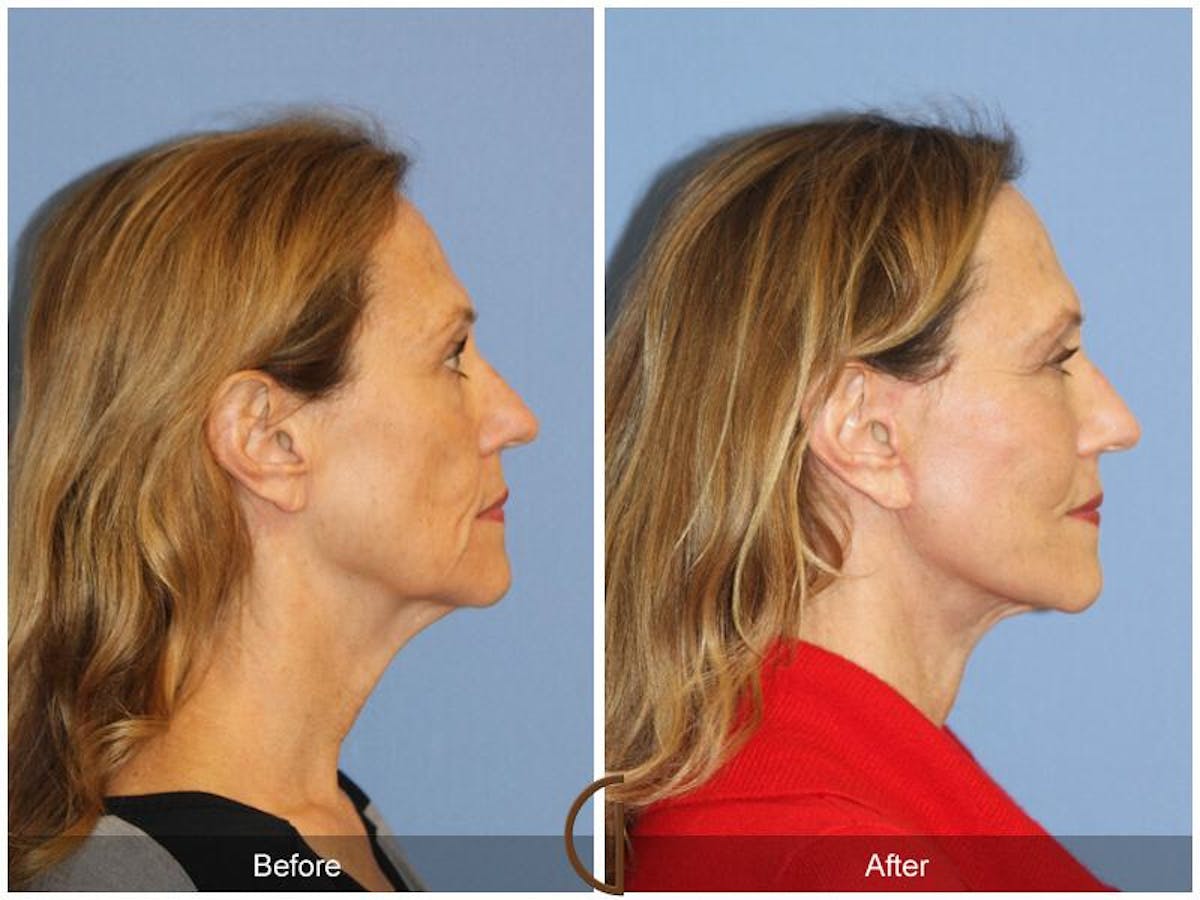 Facelift 50s Before & After Gallery - Patient 263333 - Image 3