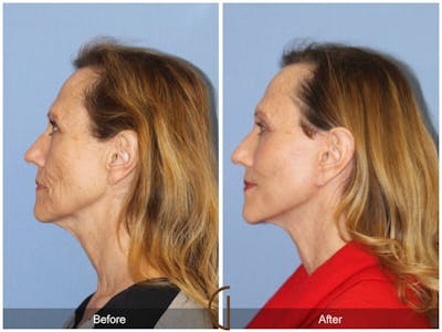 Facelift 50s Before & After Gallery - Patient 263333 - Image 1