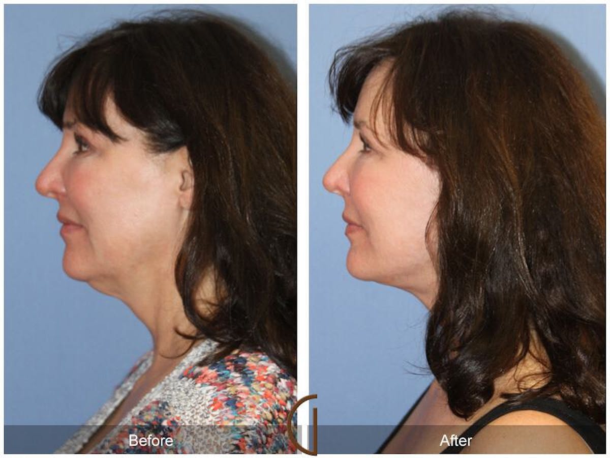 Facelift 50s Before & After Gallery - Patient 406440 - Image 1