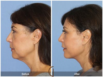 Facelift 50s Before & After Gallery - Patient 152531 - Image 1