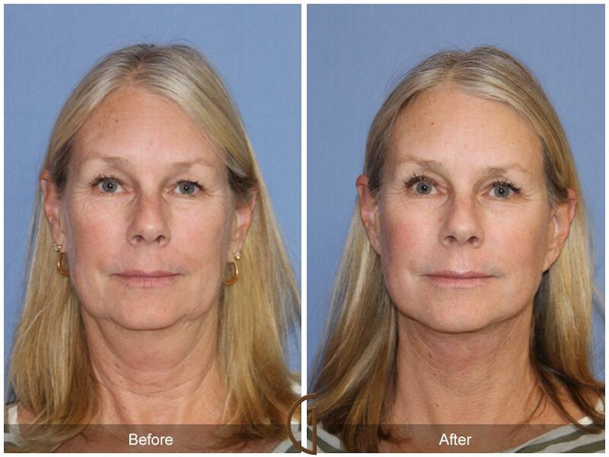 Facelift 50s Before & After Gallery - Patient 417748 - Image 2