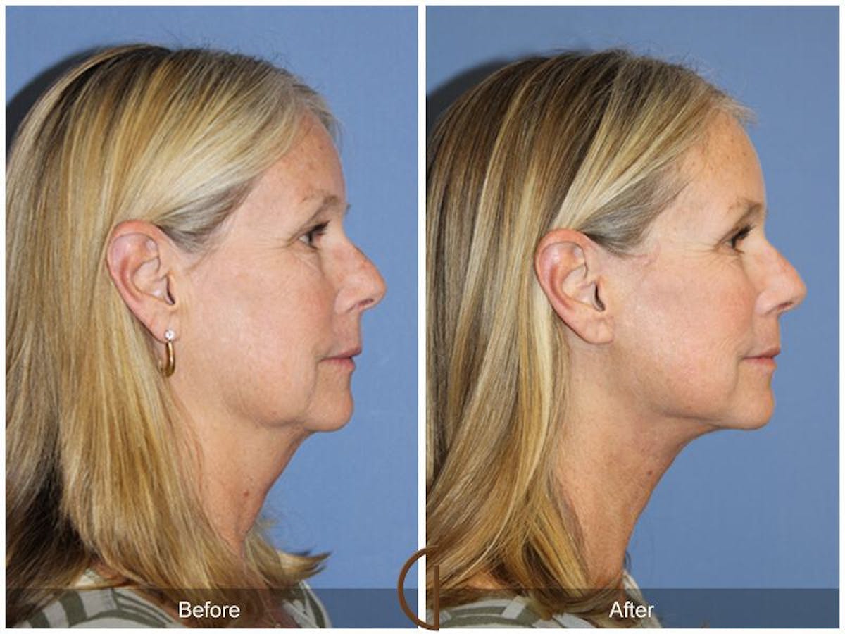 Facelift 50s Before & After Gallery - Patient 417748 - Image 3