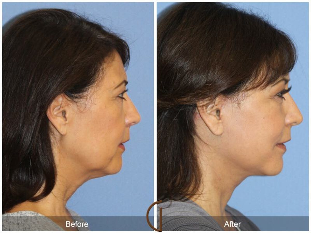Facelift 50s Before & After Gallery - Patient 152531 - Image 3