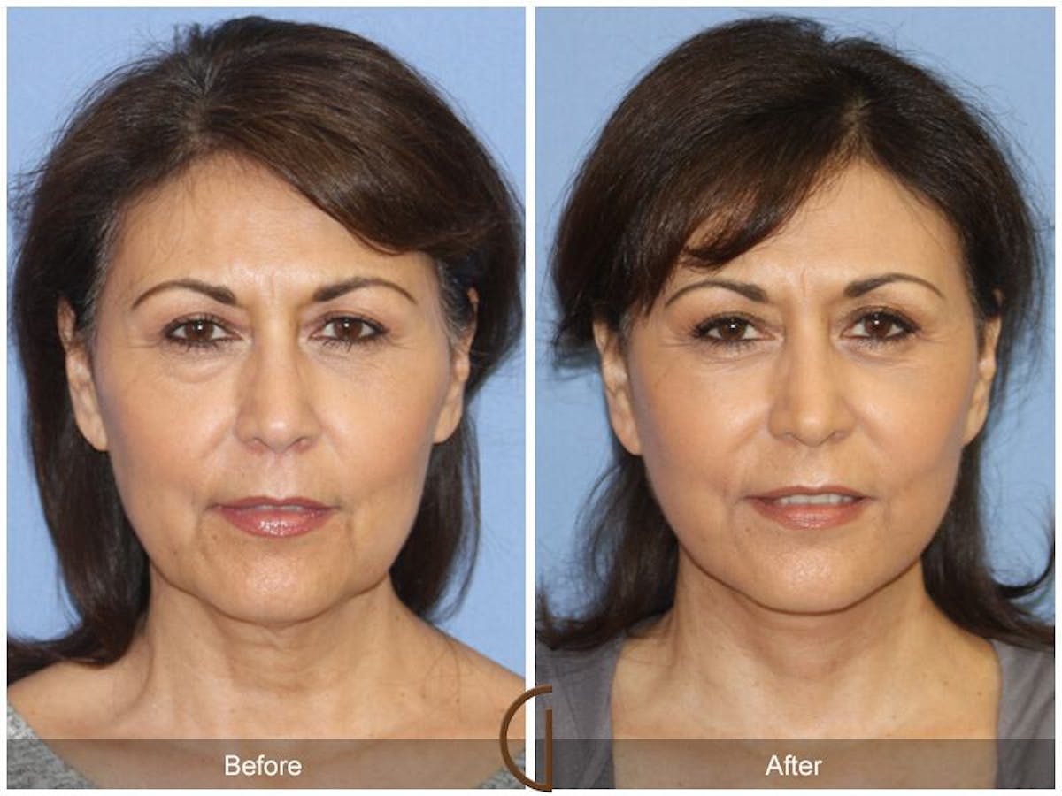 Facelift 50s Before & After Gallery - Patient 152531 - Image 2