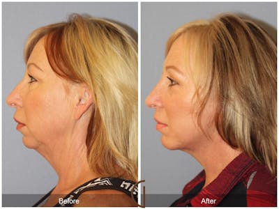 Neck Lift Before & After Gallery - Patient 325274 - Image 1
