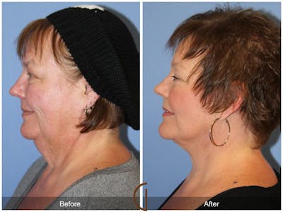 Facelift 50s Before & After Gallery - Patient 258479 - Image 1