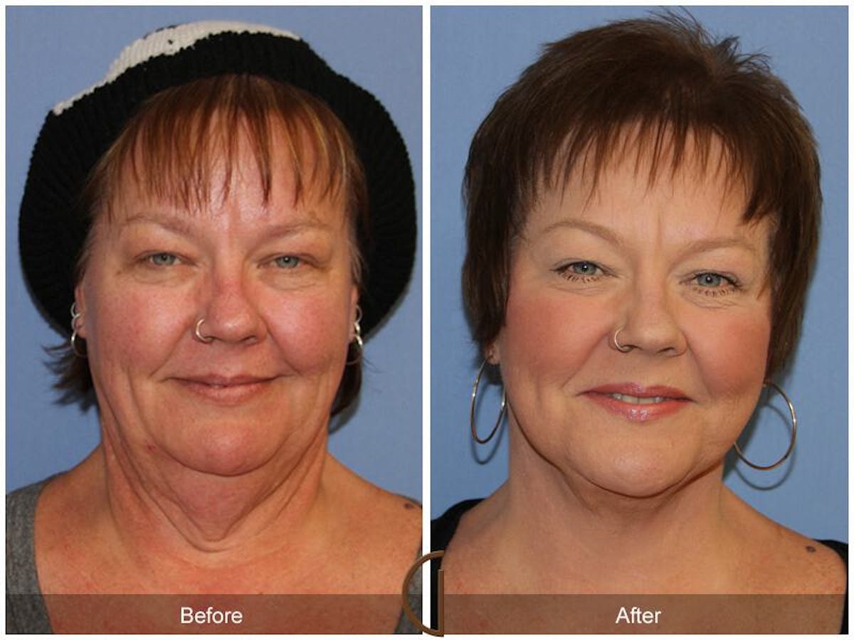 Facelift 50s Before & After Gallery - Patient 258479 - Image 2