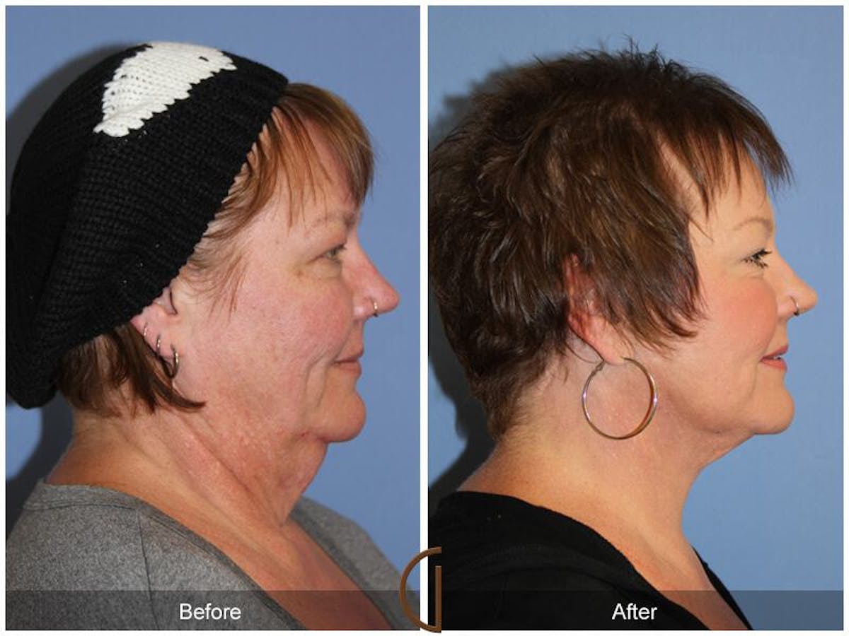 Facelift 50s Before & After Gallery - Patient 258479 - Image 3