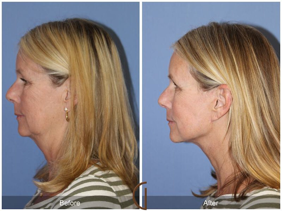Facelift 50s Before & After Gallery - Patient 417748 - Image 1