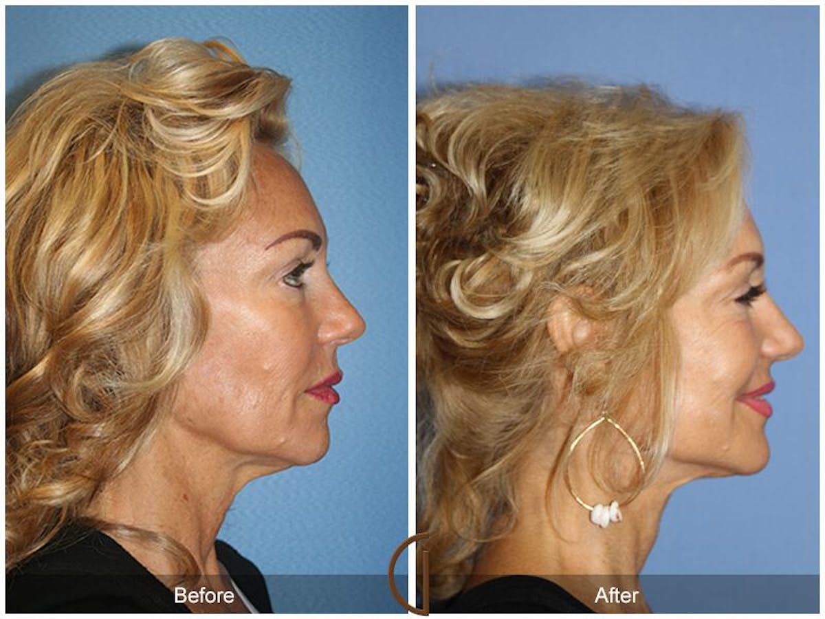 Facelift 60s Before & After Gallery - Patient 265584 - Image 3
