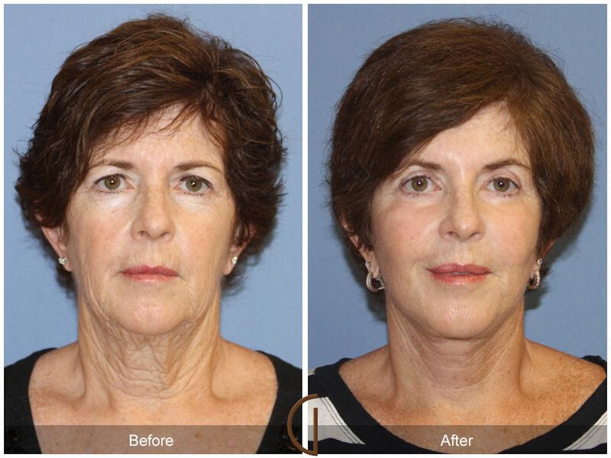 Facelift 60s Before & After Gallery - Patient 261808 - Image 2