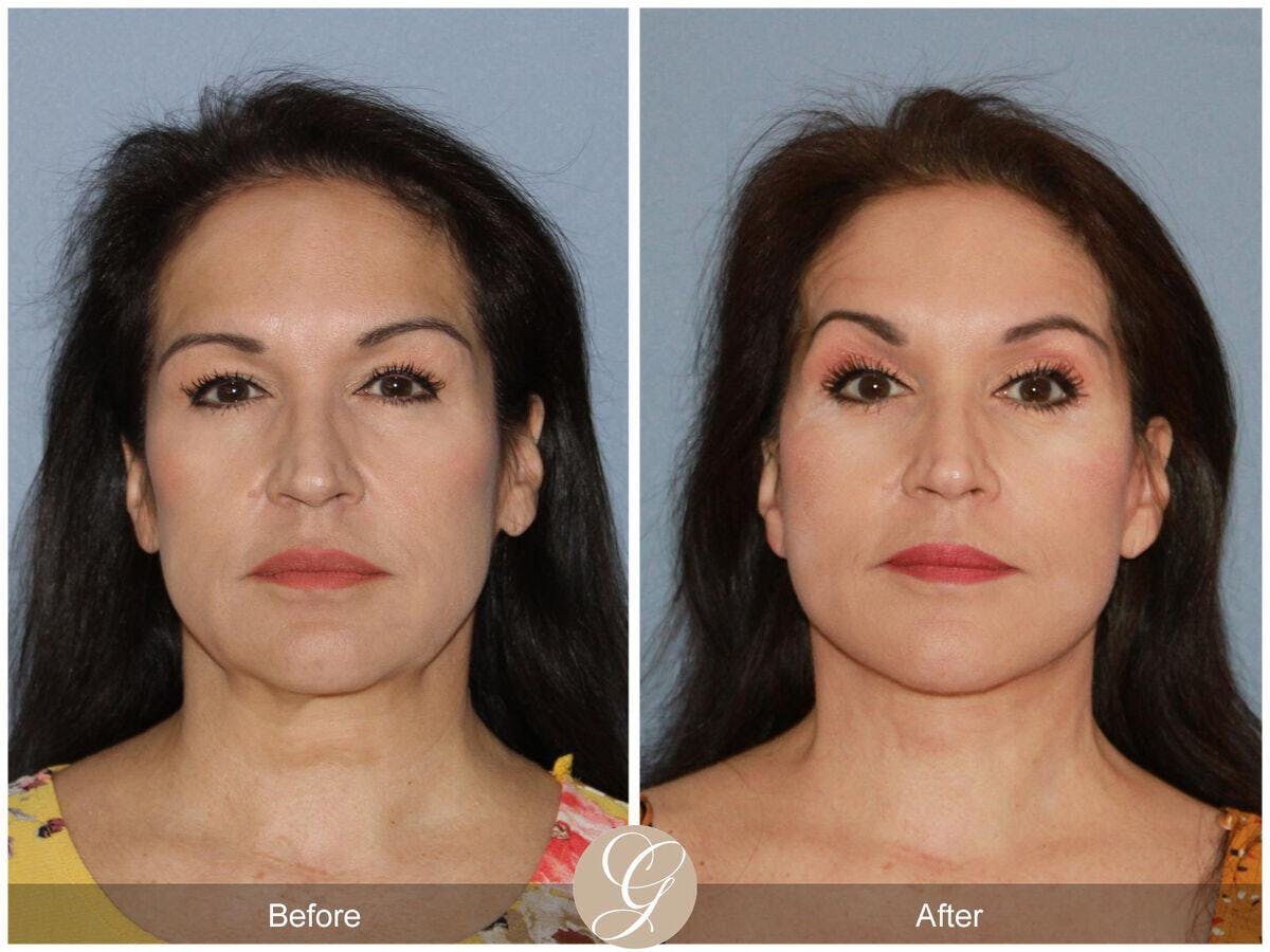 Facelift 50s Before & After Gallery - Patient 425820 - Image 2