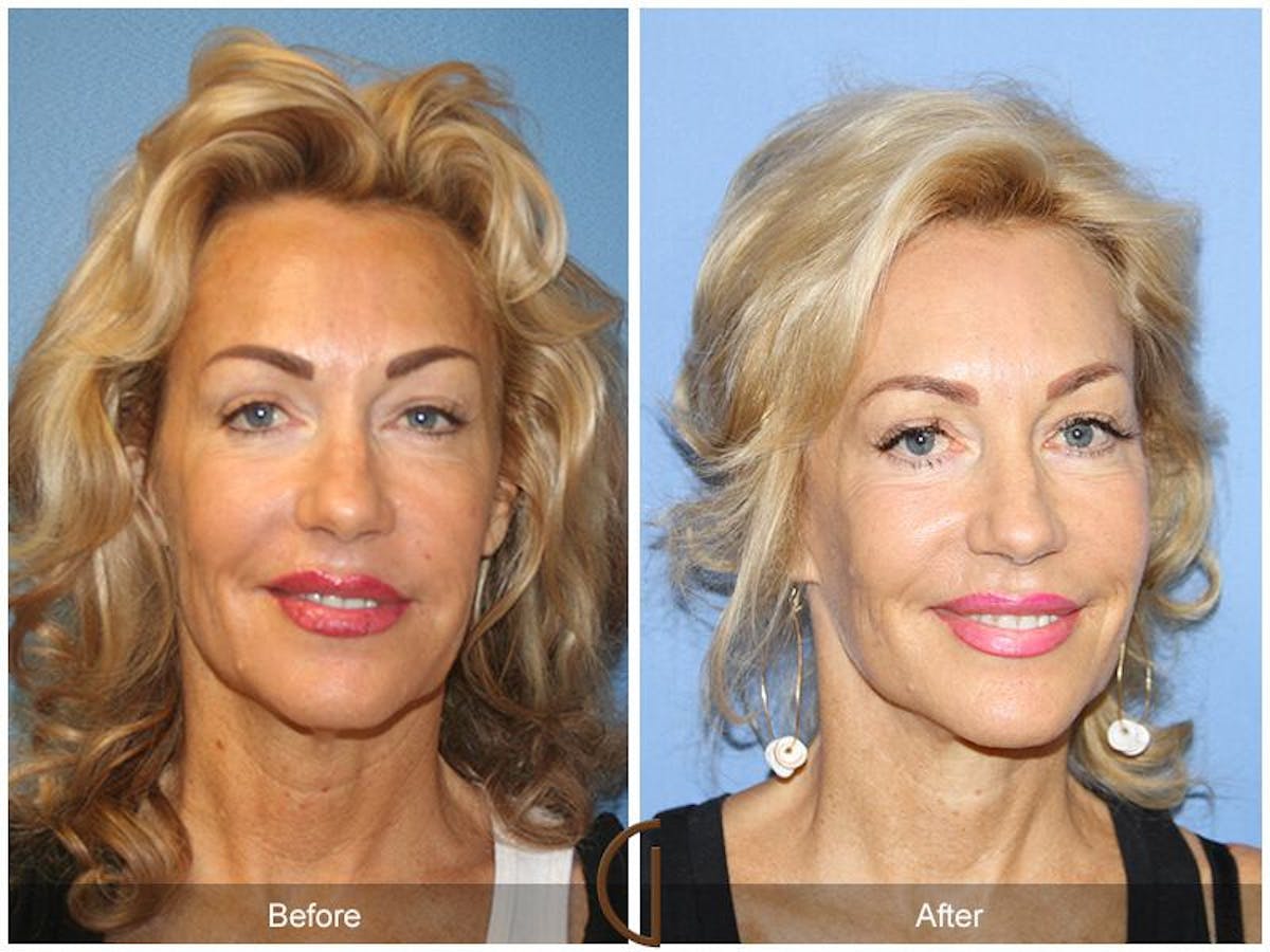 Facelift 60s Before & After Gallery - Patient 265584 - Image 2