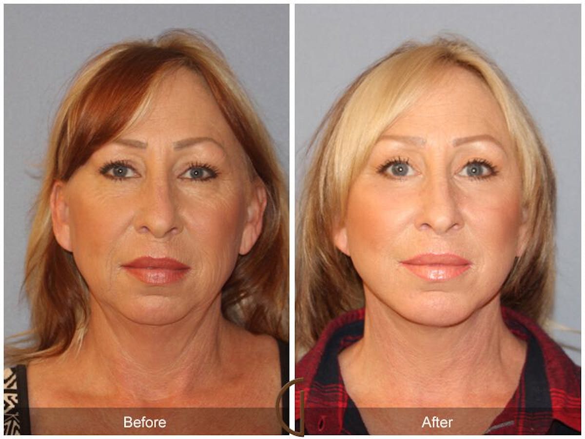 Facelift 40s Before & After Gallery - Patient 298202 - Image 2