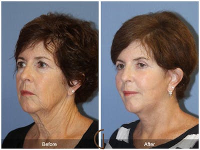 Neck Lift Before & After Gallery - Patient 129871 - Image 1