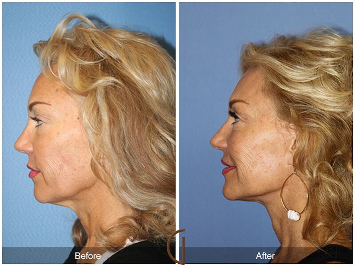 Facelift 60s Before & After Gallery - Patient 265584 - Image 1