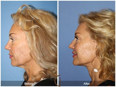 Facelift 60s Before & After Gallery - Patient 265584 - Image 1
