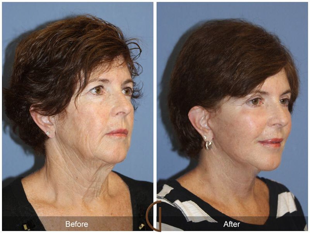 Facelift 60s Before & After Gallery - Patient 261808 - Image 3