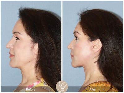 Facelift 50s Before & After Gallery - Patient 425820 - Image 1