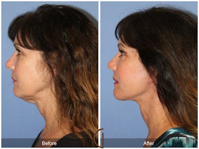 Facelift 50s Before & After Gallery - Patient 146368 - Image 1