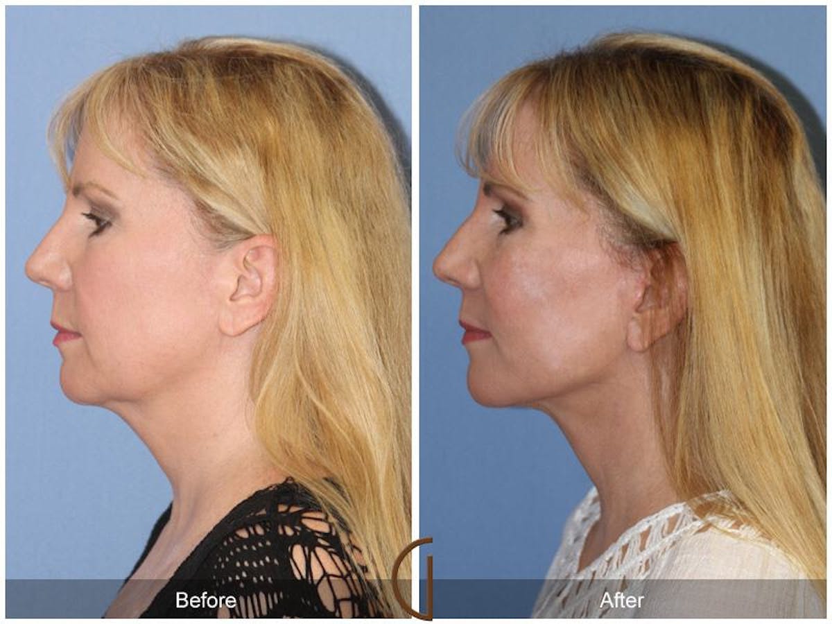Facelift 50s Before & After Gallery - Patient 770579 - Image 1