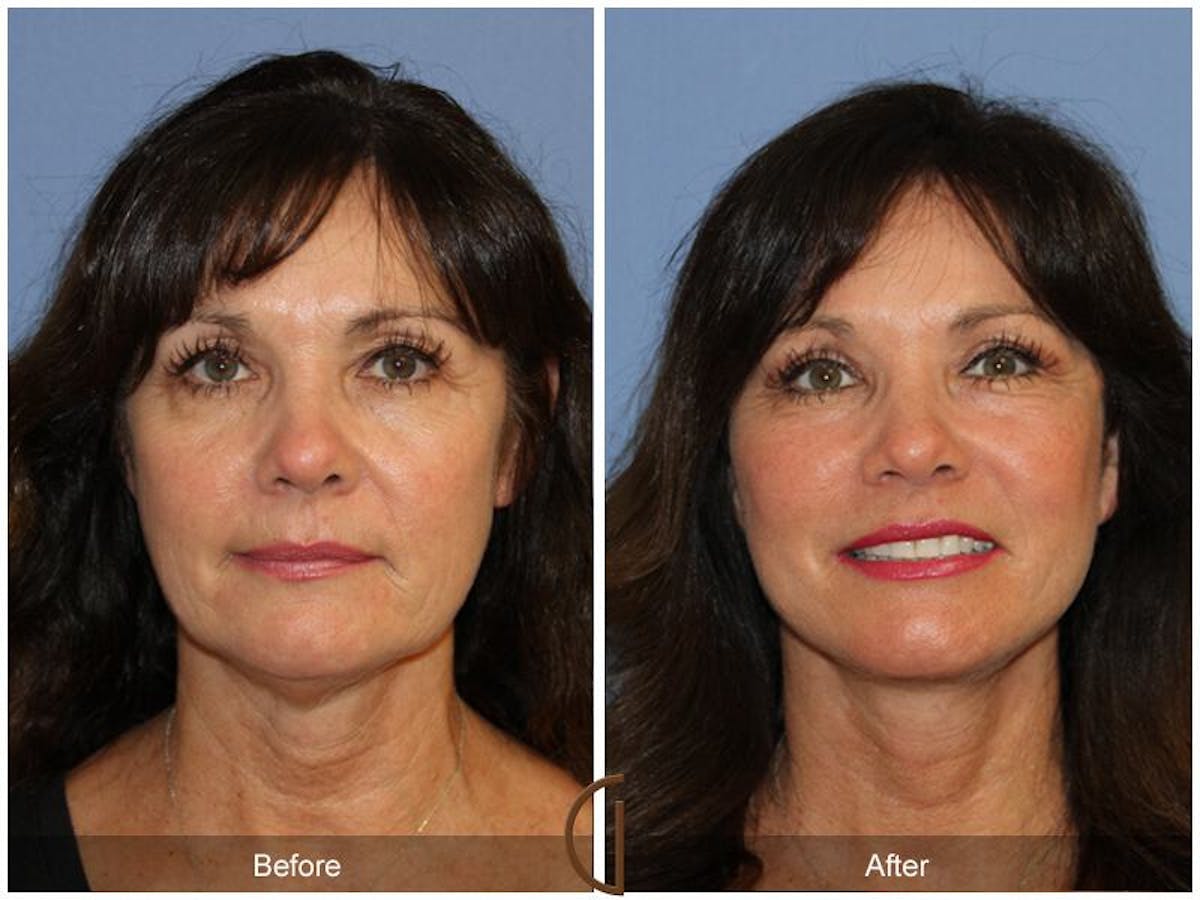 Facelift 50s Before & After Gallery - Patient 146368 - Image 2