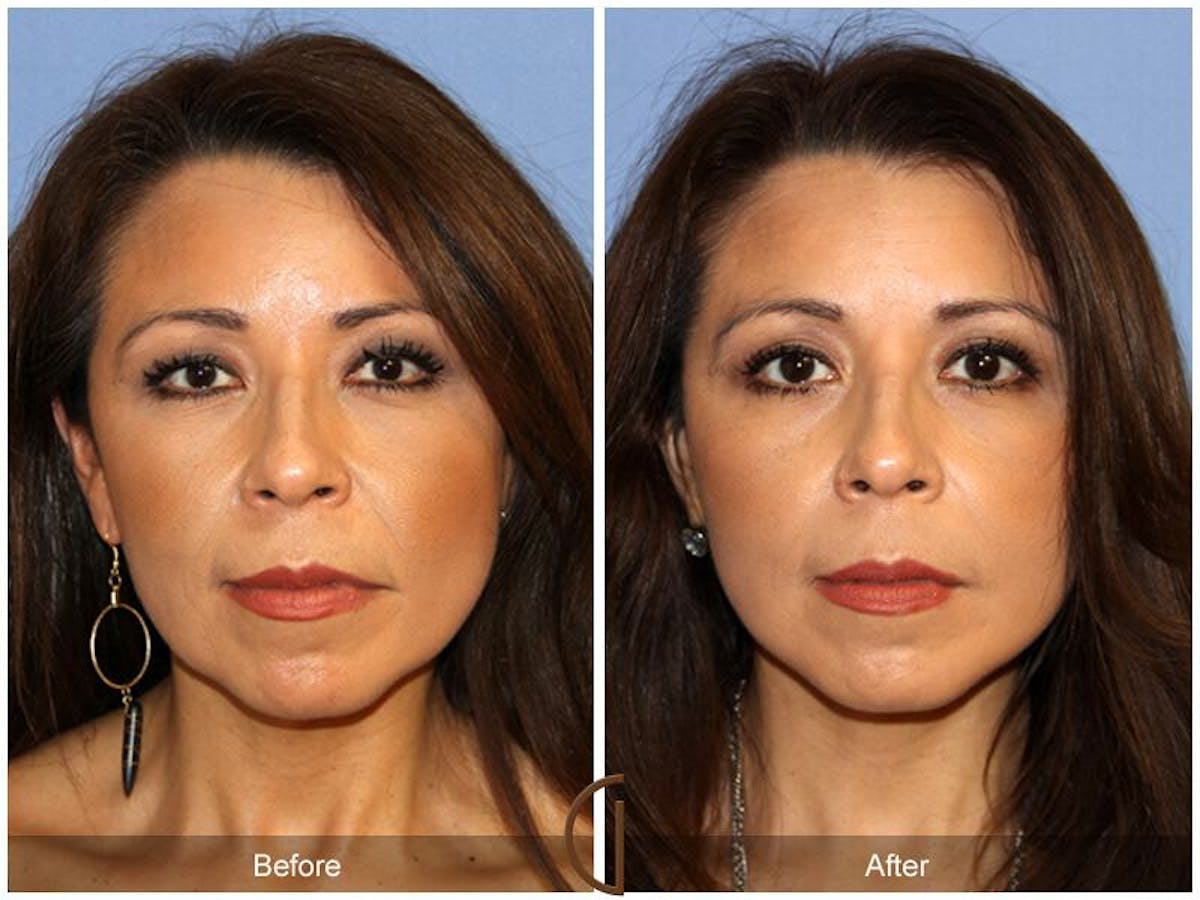 Facelift 50s Before & After Gallery - Patient 235406 - Image 2