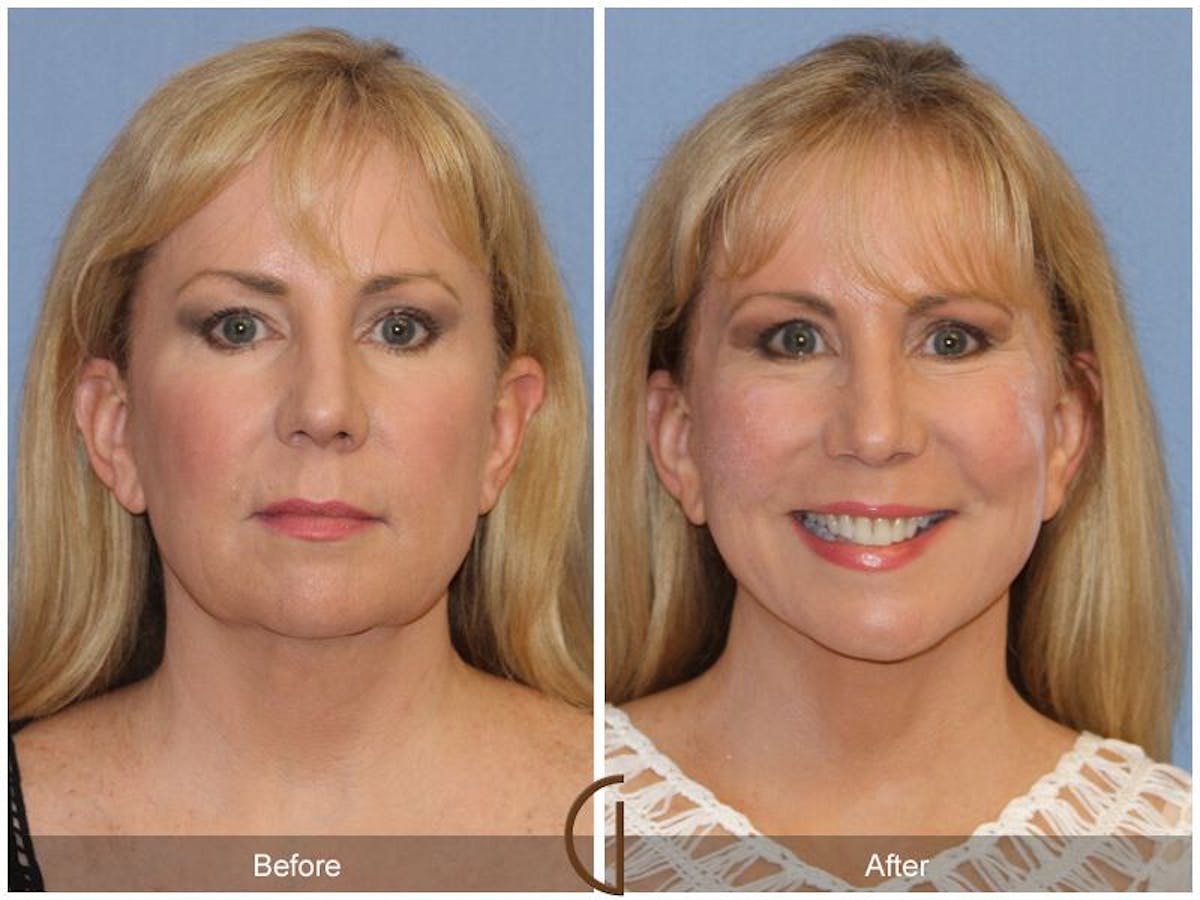 Facelift 50s Before & After Gallery - Patient 770579 - Image 2